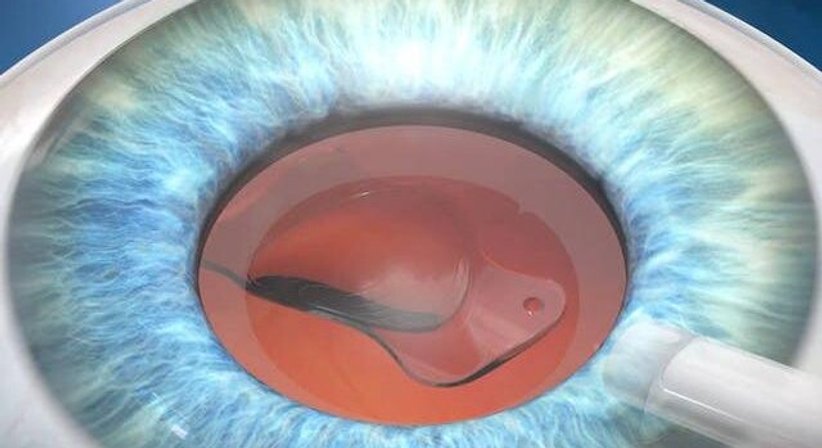 Linsenaustausch bei Alterssichtigkeit - Priv.-Doz. DDr. Gernot Steinwender - Augenarzt Graz 8010