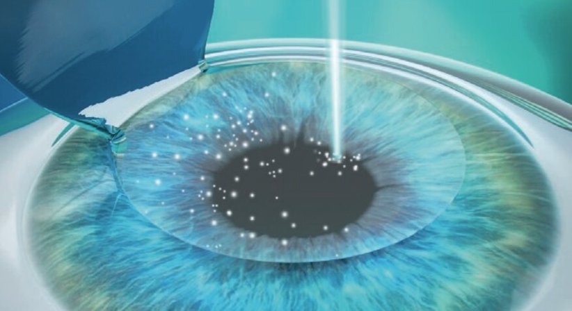 Augenlaser (SmartSight, Femto-LASIK, Trans-PRK) - Priv.-Doz. DDr. Gernot Steinwender - Augenarzt Graz 8010