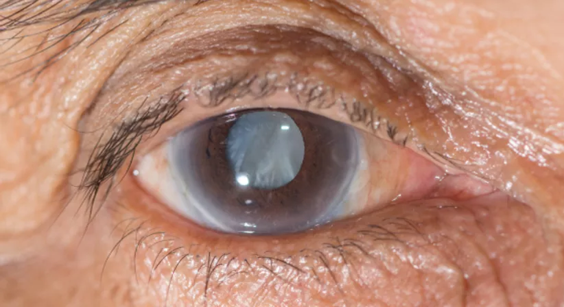 Grauer Star - Priv.-Doz. Dr. Hemma Resch - Augenärztin Wolkersdorf 2120