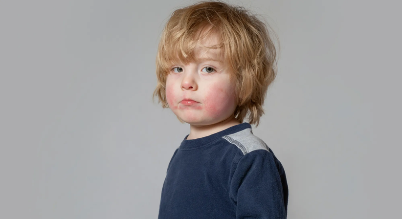 Kinderdermatologie - Dr. Ines Schwarz - Hautärztin Wien 1090