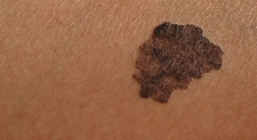 Muttermalkontrolle - Dr. Ines Schwarz - Hautärztin Wien 1090