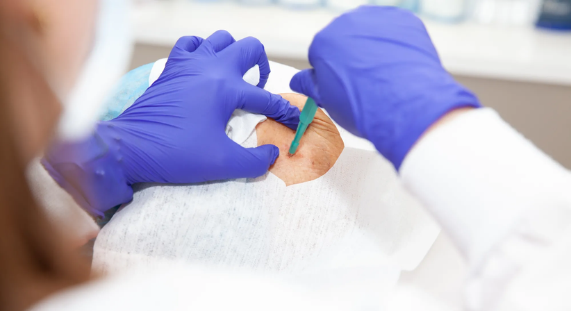 Dermatochirurgie - Dr. Ines Schwarz - Hautärztin Wien 1090