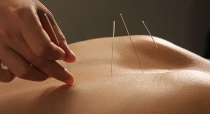 Akupunktur