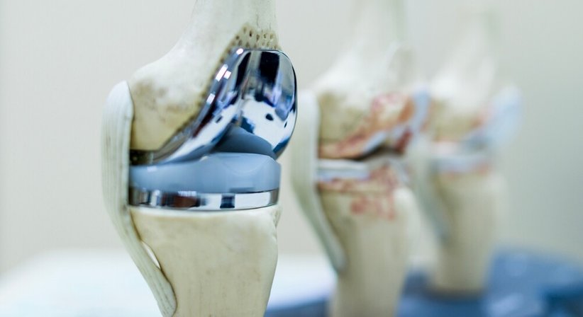 Arthrose (Halbschlitten, Knie TEP) - OA Ing. Dr. med. Benjamin Schett - Orthopäde Groß Gerungs 3920