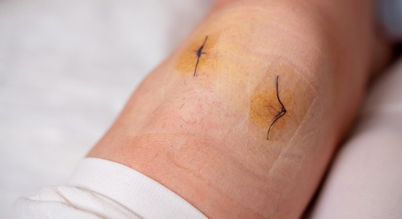 Knie Arthroskopie - OA Ing. Dr. med. Benjamin Schett - Orthopäde Groß Gerungs 3920