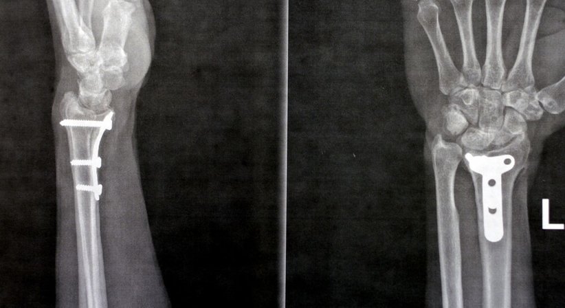 Metallentfernung bei Dr. Oliver Pieper