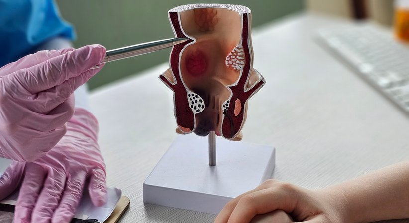 Hämorrhoiden Gummibandligatur - Internist-Nord – Gruppenpraxis für Innere Medizin -  Wien 1210