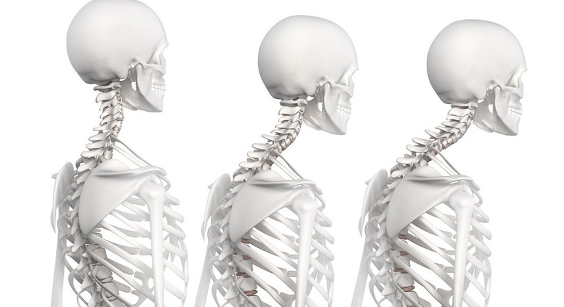 Kyphose - a.o.Univ.Prof.Dr. Josef Georg Grohs - Orthopäde Wien 1190