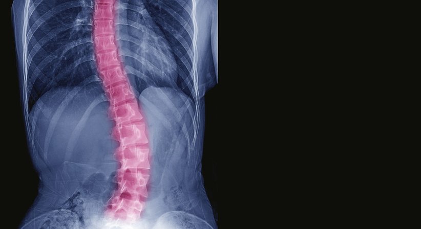 Skoliose - a.o.Univ.Prof.Dr. Josef Georg Grohs - Orthopäde Wien 1190