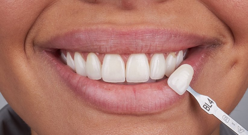 Ästhetische Zahnheilkunde - Dr. Alissa Wiederin, MSc - Zahnärztin Höchst 6973