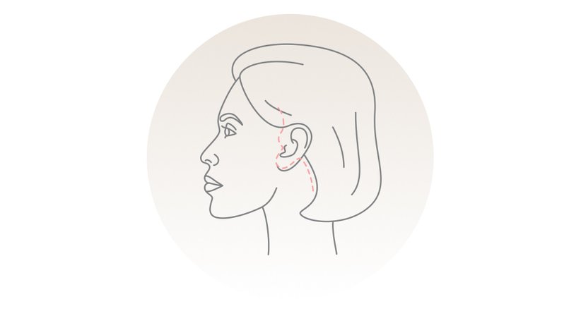 Facelift - Dr. Philipp Hüttinger - Plastischer Chirurg Wien 1010