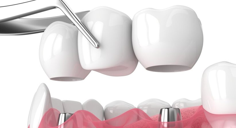 Kronen, Brücken, In&Onlays - Dr. Maximilian Putz - Zahnarzt Wien 1020