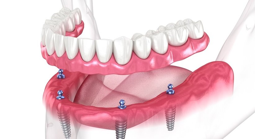 Dentalphobie - Dr. Maximilian Putz - Zahnarzt Wien 1020