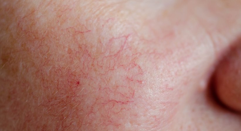 Couperose, Gefäße, Blutschwämmchen - Dr. med. Clemens Frisee - Hautarzt Wien 1130