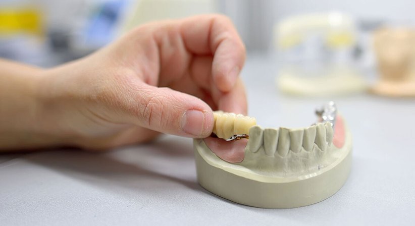 Zahnsanierung - Dr. med. univ. Cora Haller-Waschak - Zahnärztin Wien 1180