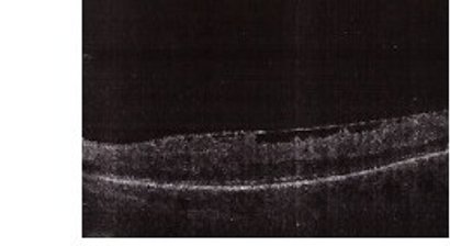 Netzhauterkrankungen und -operationen