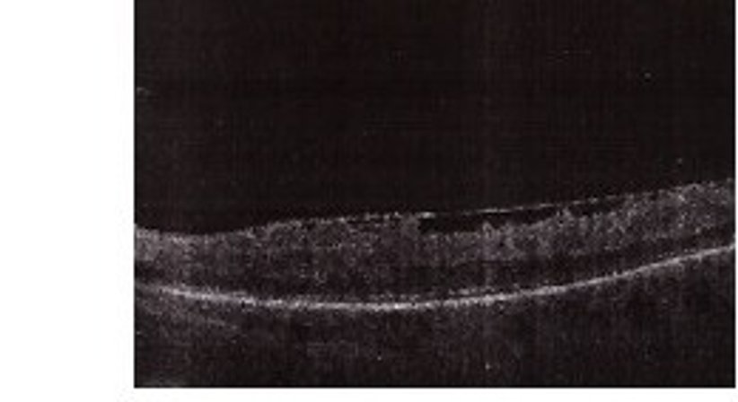 Netzhauterkrankungen und -operationen - Priv.-Doz. Dr. Katharina Kubista - Augenärztin Wien 1090