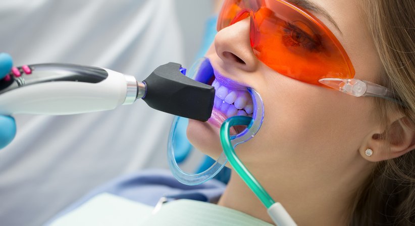 Bleaching - DDr. Claudius Kwapinski - Zahnarzt Wien 1230