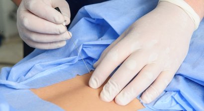 Facettengelenksdenervierung