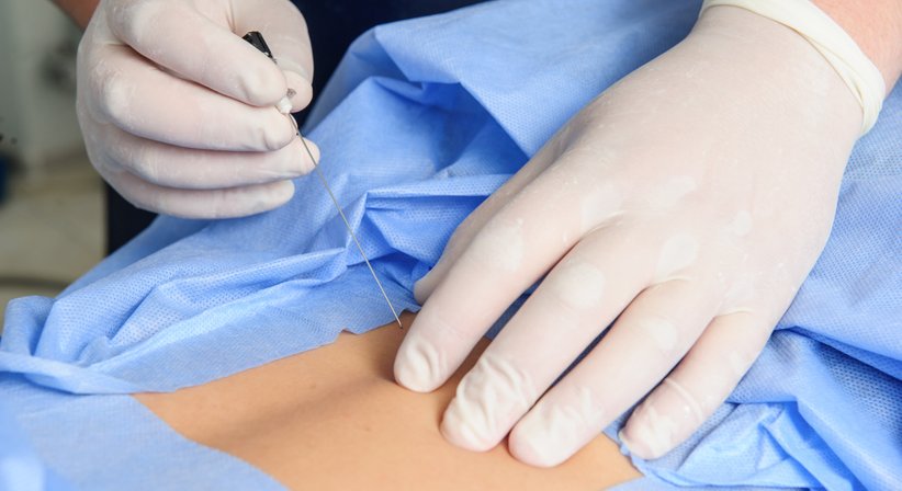 Facettengelenksdenervierung - OA Dr. Rene Simon - Orthopäde Baden 2500