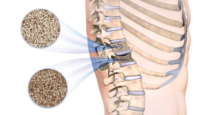 Osteoporose - OA Dr. Rene Simon - Orthopäde Baden 2500