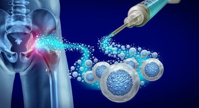 Stammzellentherapie (ACA-SVF)