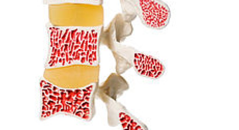 Knochendichtemessung - Dr. Thomas Mader - Radiologe Mödling 2340