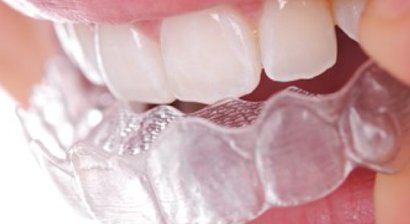 Invisalign - Unsichtbare Zahnkorrektur