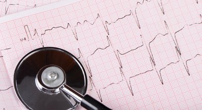 Behandlung von Herzrhythmusstörungen und Vorhofflimmern