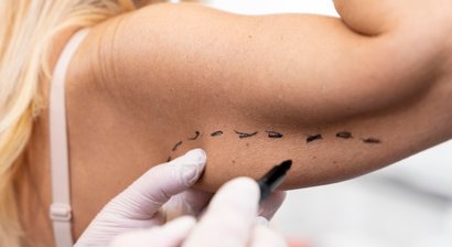 Körperstraffungen (Po- und Oberschenkelstraffung/Oberarmstraffung)