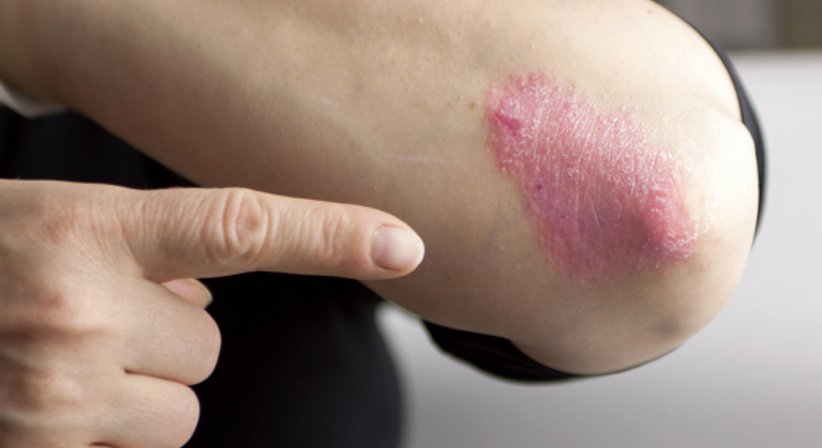 Chronische Nesselsucht (Urtikaria) - Univ.Prof. Dr. med. univ. Georg Stingl - Hautarzt Wien 1090