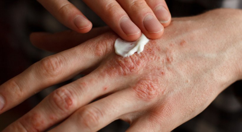 Neurodermitis - Univ.Prof. Dr. med. univ. Georg Stingl - Hautarzt Wien 1090