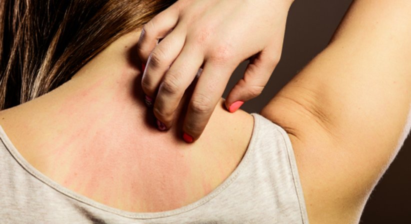 Schuppenflechte - Univ.Prof. Dr. med. univ. Georg Stingl - Hautarzt Wien 1090