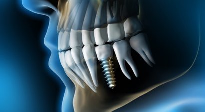 Zahnimplantate