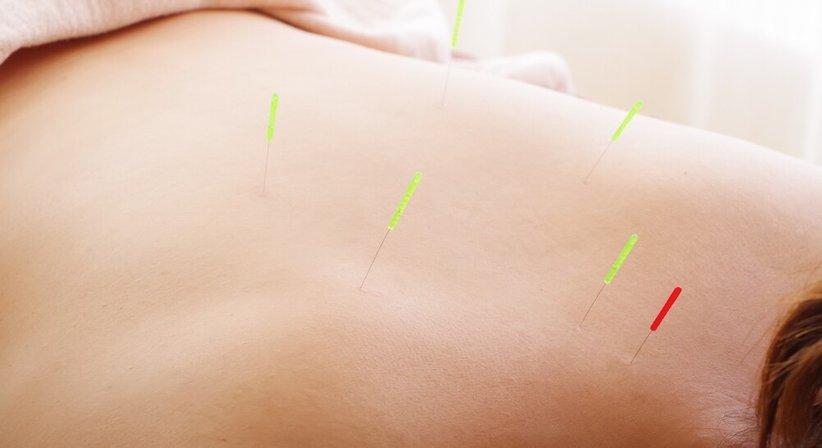 Akupunktur - Dr. Kerstin Glössmann - Neurologin Baden 2500