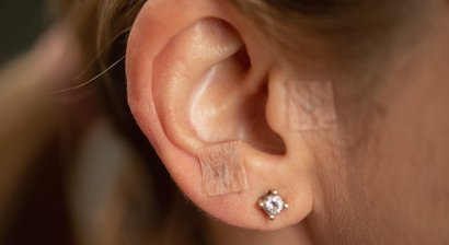 Französische Ohrakupunktur