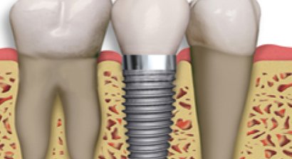 Zahnimplantate