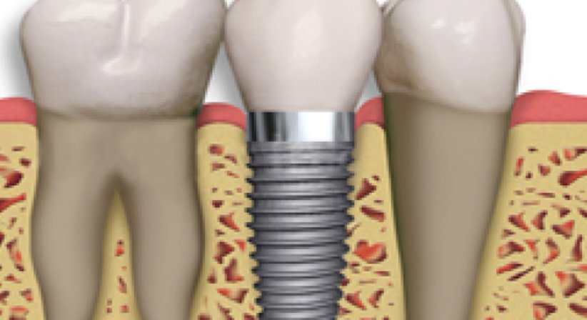 Zahnimplantate - DDr. Anna Piotrowski - Zahnärztin Wien 1030