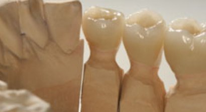 Zahnkrone und Zahnbrücke