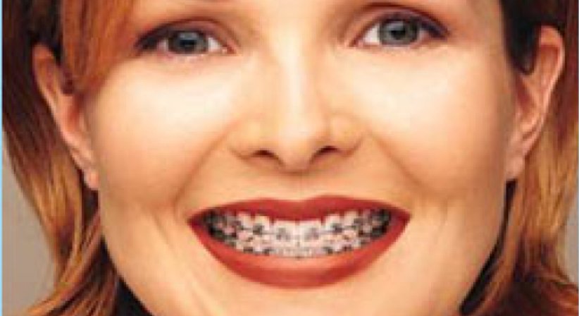 Zahnspange - DDr. Anna Piotrowski - Zahnärztin Wien 1030