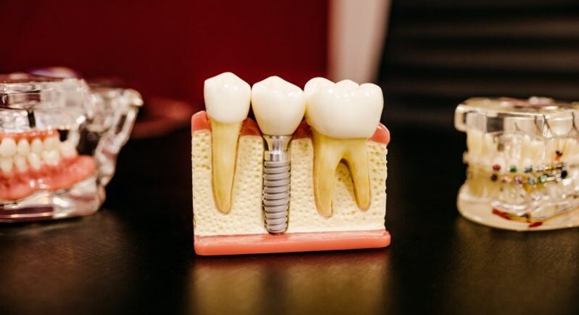 Zahnimplantate bei Dr. med. dent. Frank Bargon