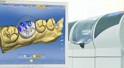 Cerec-Verfahren