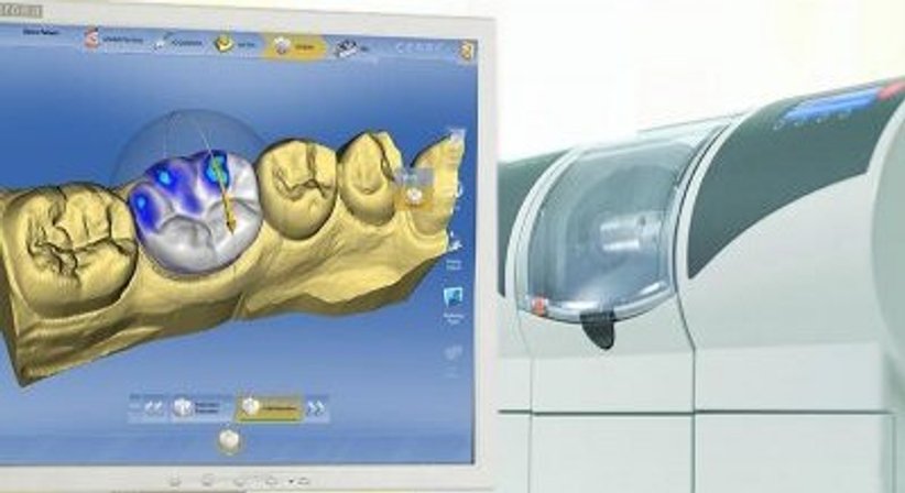 Cerec-Verfahren bei Dr. med. dent. Frank Bargon