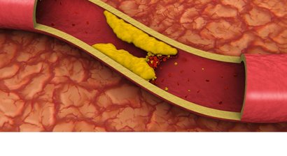 Fettstoffwechselstörungen