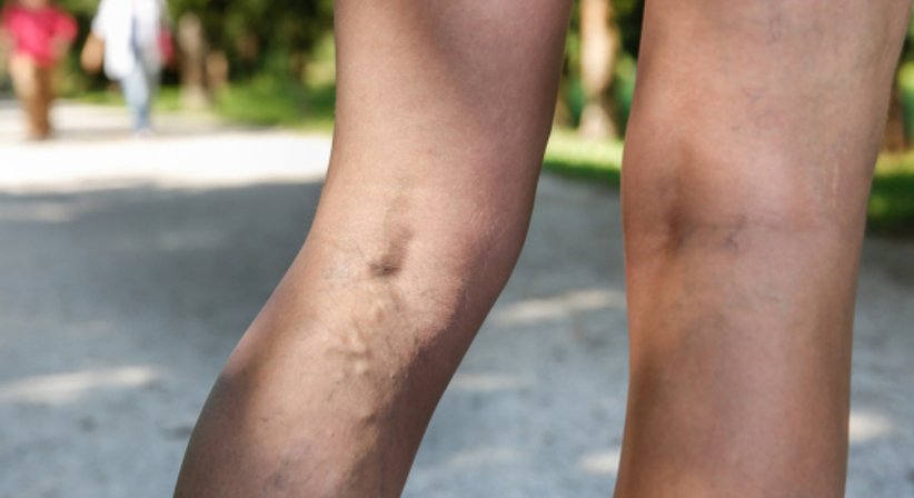 Krampfadern - Univ.Prof. Dr. Erich Minar - Internist Wien 1090