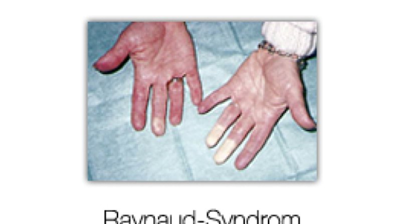 Raynaud-Symptomatik - Univ.Prof. Dr. Erich Minar - Internist Wien 1090