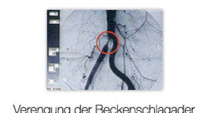 Schaufensterkrankheit