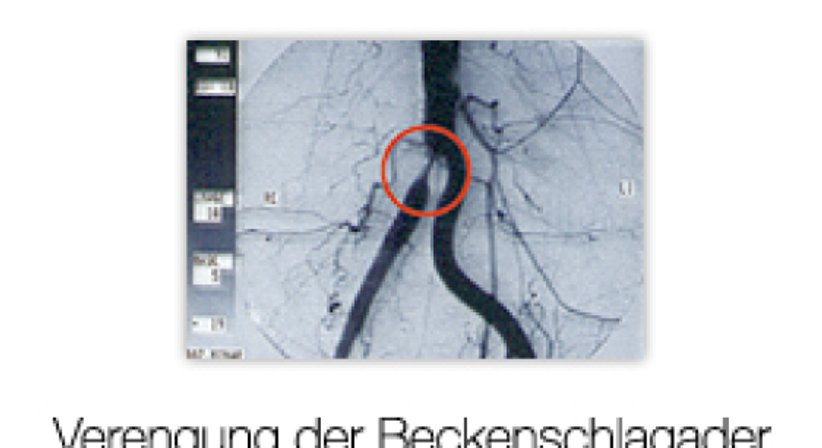 Schaufensterkrankheit - Univ.Prof. Dr. Erich Minar - Internist Wien 1090