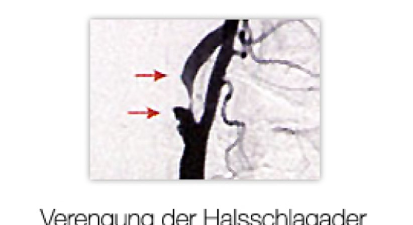 Schlaganfall - Univ.Prof. Dr. Erich Minar - Internist Wien 1090