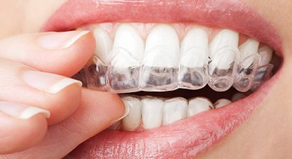 Unsichtbare Zahnspange